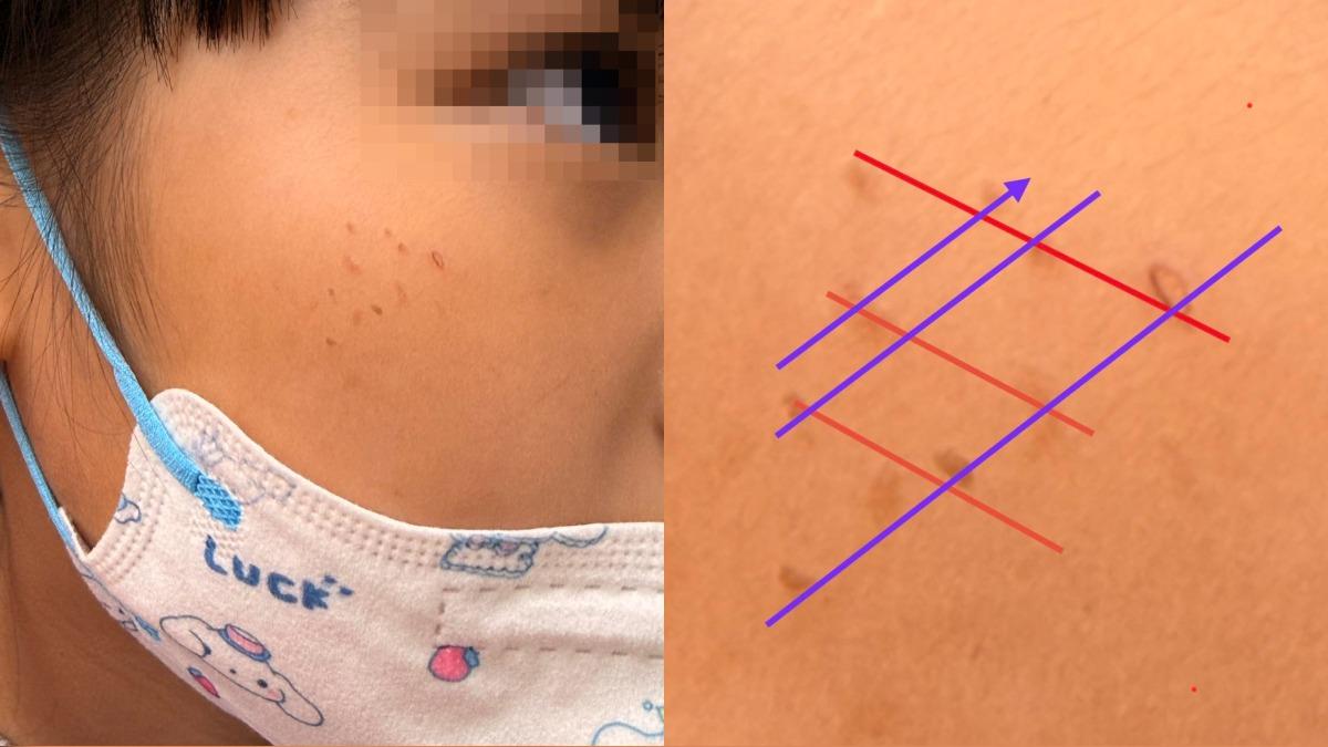 女童臉上「紅疹排排站」!醫見1狀況不對勁:毯子在作怪