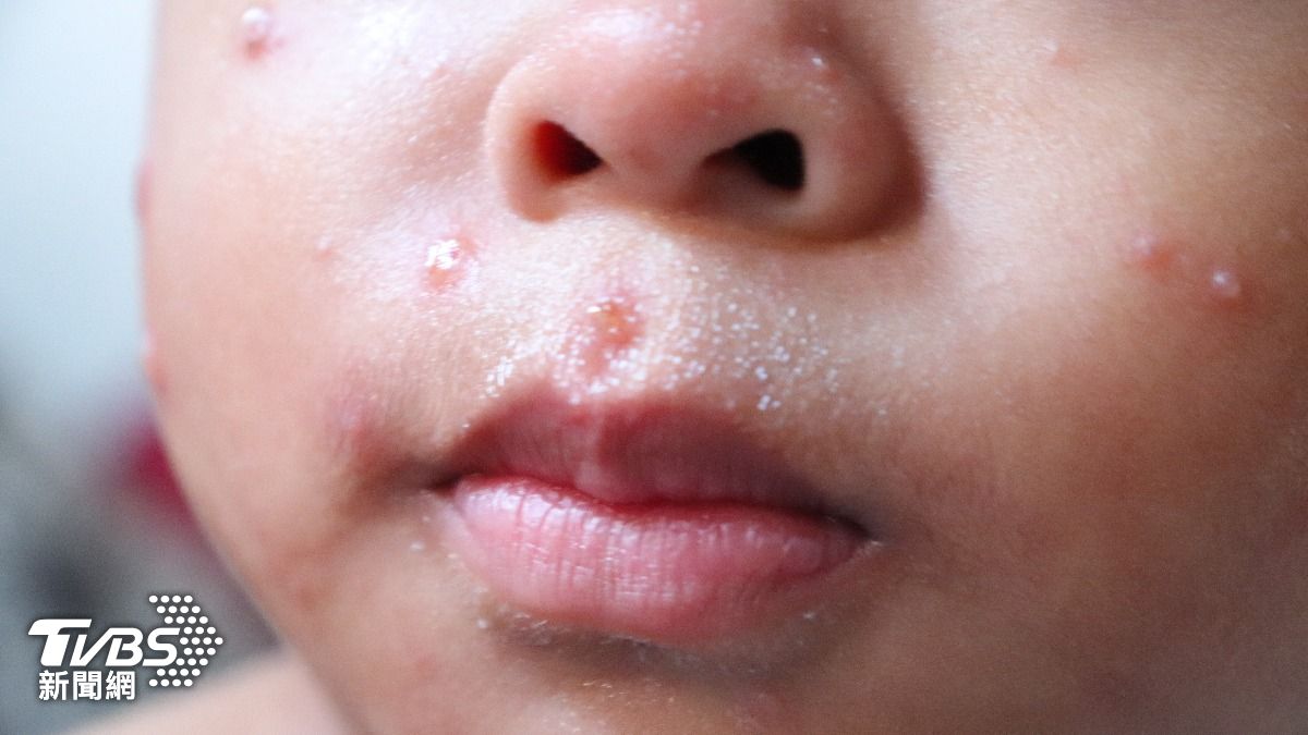 遊日注意!東京8月大男嬰染麻疹 曾搭越航310從河內飛成田