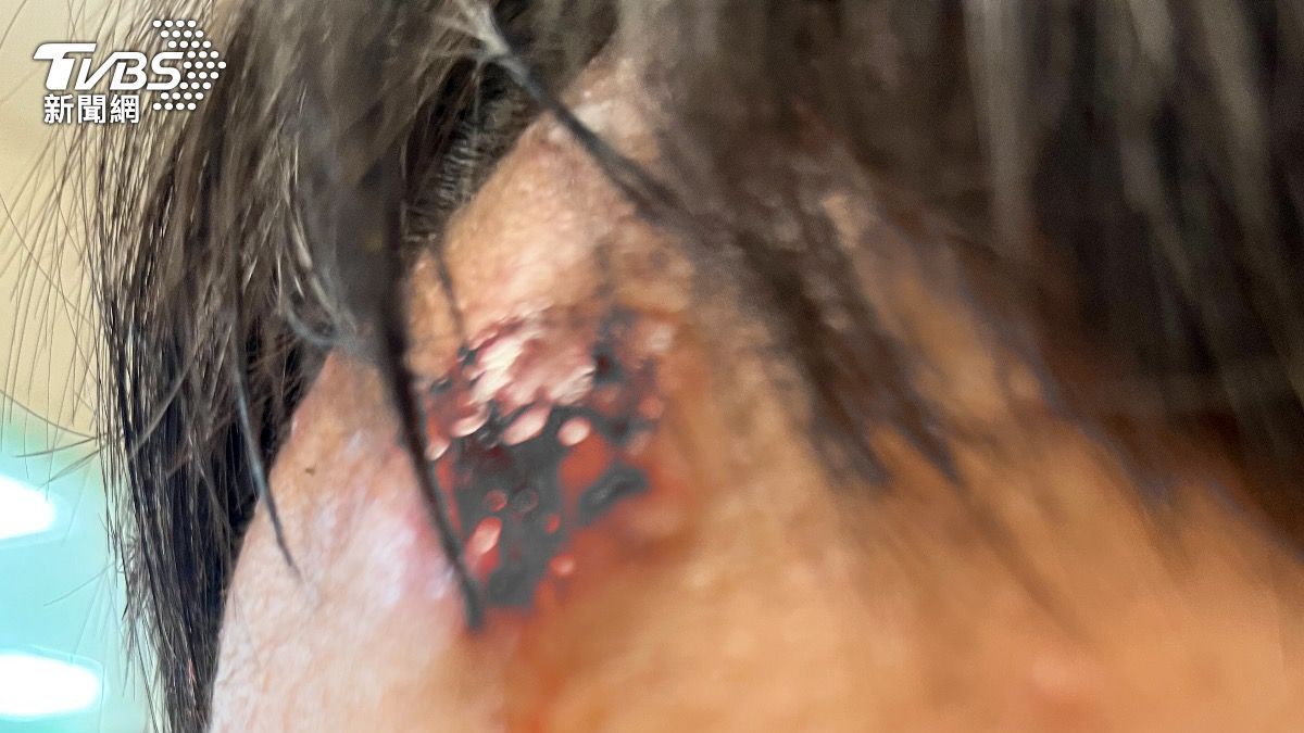 3貼自摔噴血!校長訓話未送醫還拍照 校方急發聲明