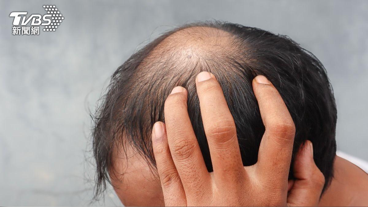 千萬韓人受掉髮所苦!李在明:禿頭攸關生死 研議納健保