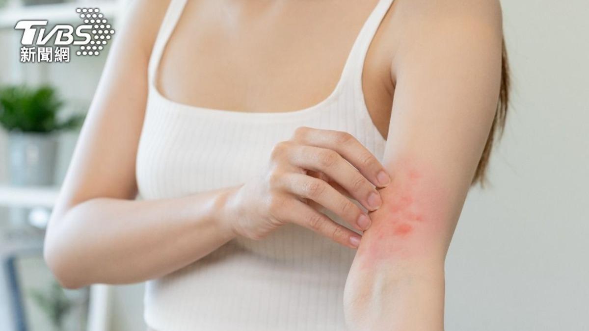 冬季皮癢脫屑好難受!醫授「保濕黃金5分鐘」 3狀況快就醫