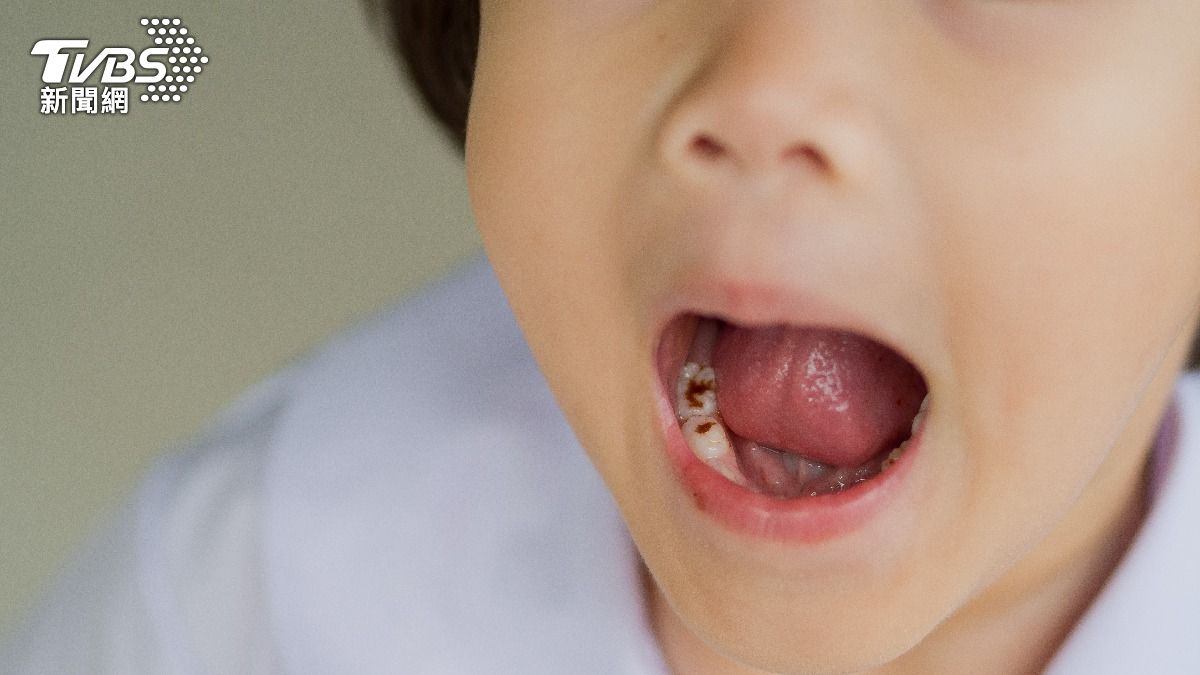 6歲童吃飯狂哭不配合 醫檢查「一口爛牙」問題竟不在吃糖