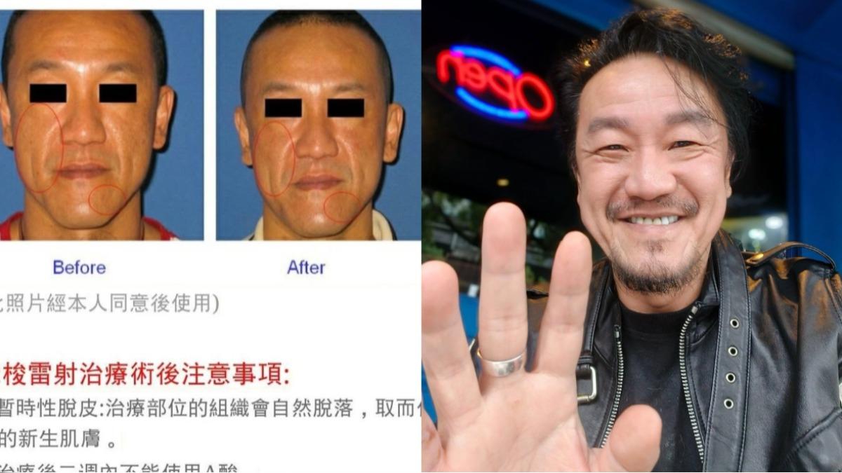 醫美模特打馬仍被認出!網一看秒喊「是陳為民」 釣出本人神回覆