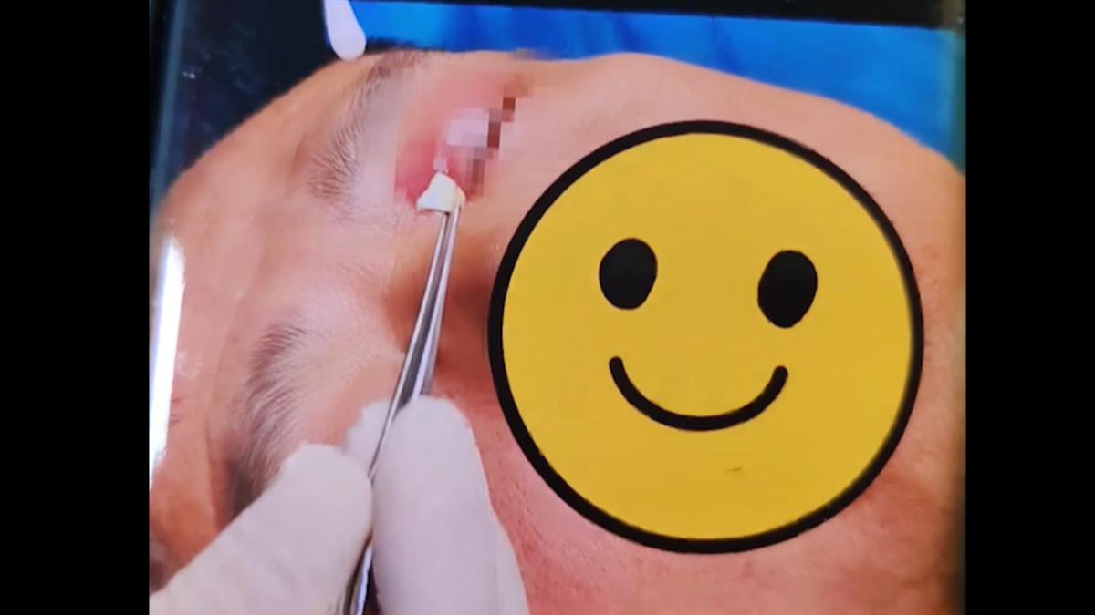 眼睛痛竟拔出筆頭!陸男回想「27年前被戳眼」 醫驚:比眼球長