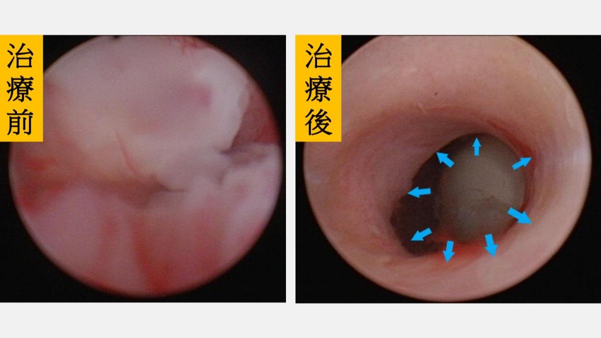 小便痛竟是罕見癌!台中婦尿道塞滿腫瘤 醫嘆:剩53%能活