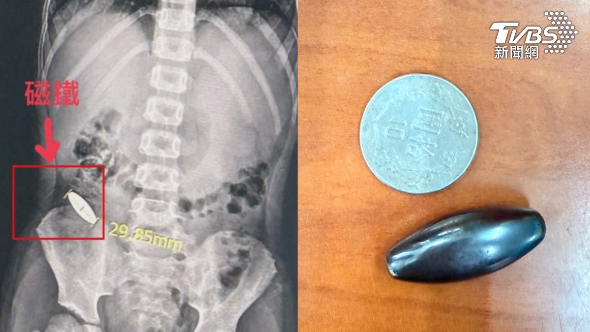 台南童遭學長霸凌「逼吞3公分磁鐵」　半夜嚇哭問爸媽：會一直卡肚裡嗎