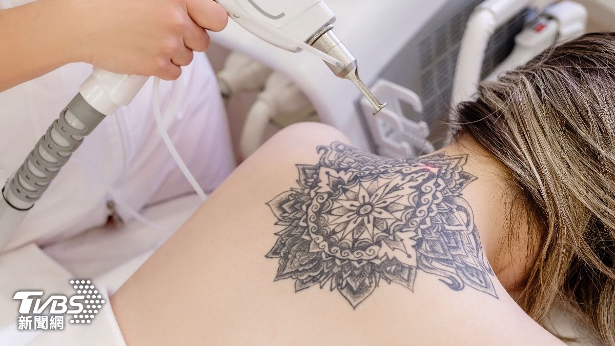 整形醫生曝「雷射除刺青」原理 顏色、位置不同差異大