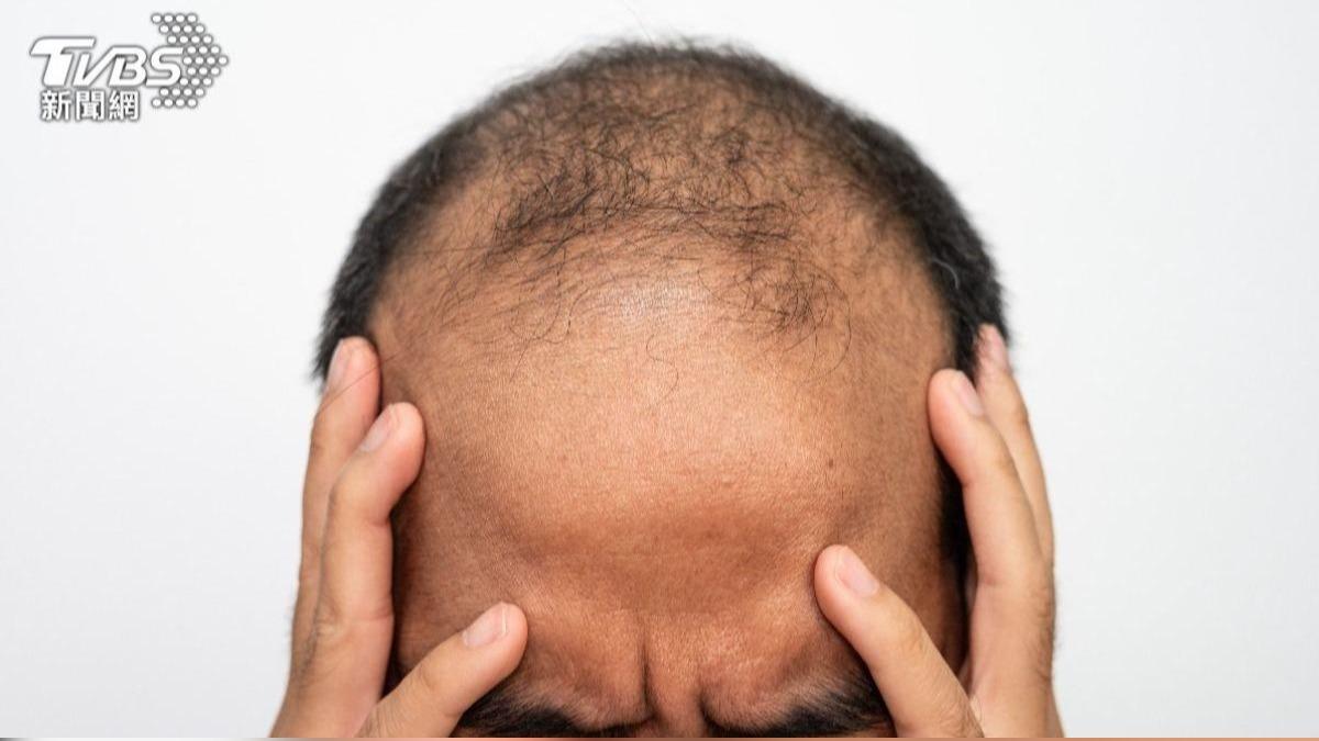 解決滲透頭皮問題!澳洲新研究:生髮水加一配方促進功效