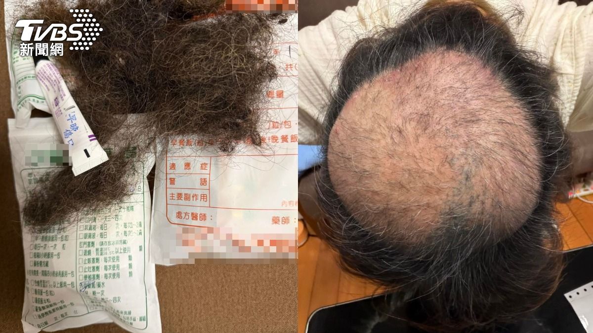 網友長期被異味影響,身心焦慮到拔光頭髮。(圖/當事人提供) 圖/網友長期被異味影響,身心焦慮到拔光頭髮。(TVBS 提供)