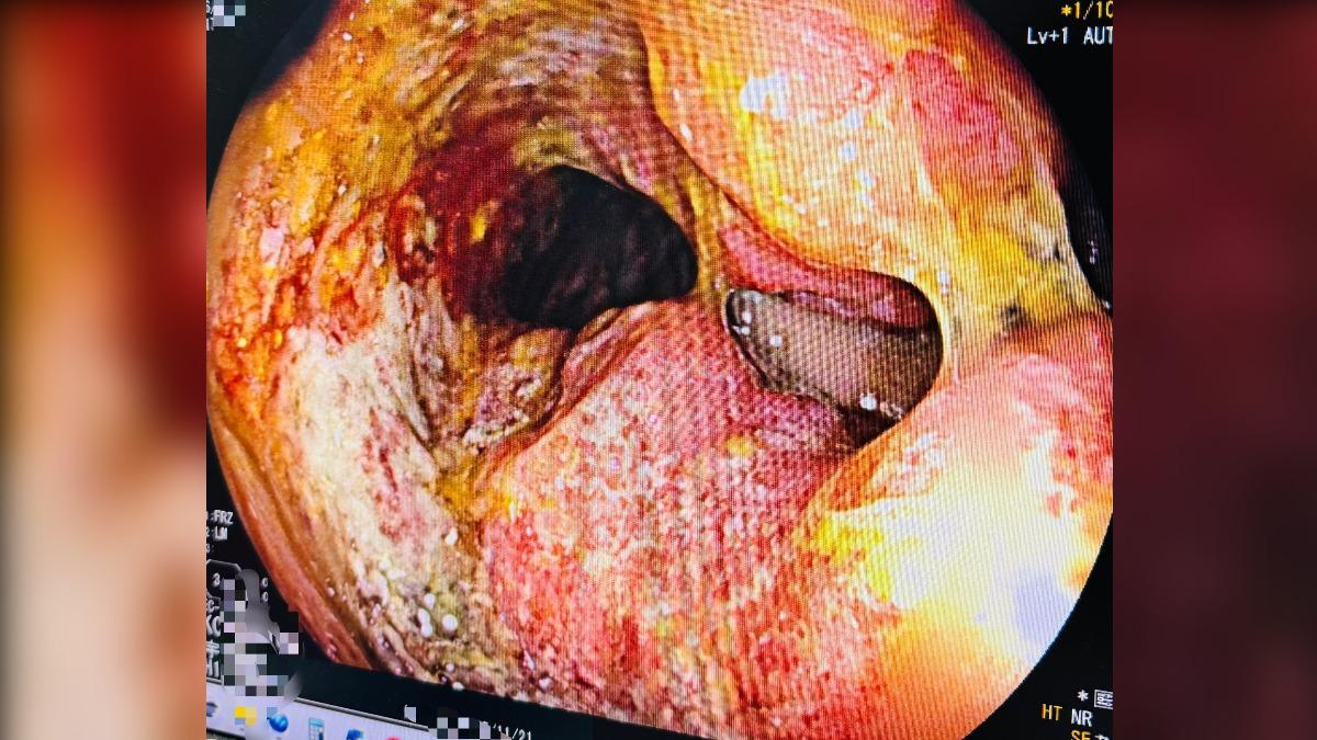 男血便半年「以為痔瘡」!年前慘罹直腸癌 3徵兆速就醫