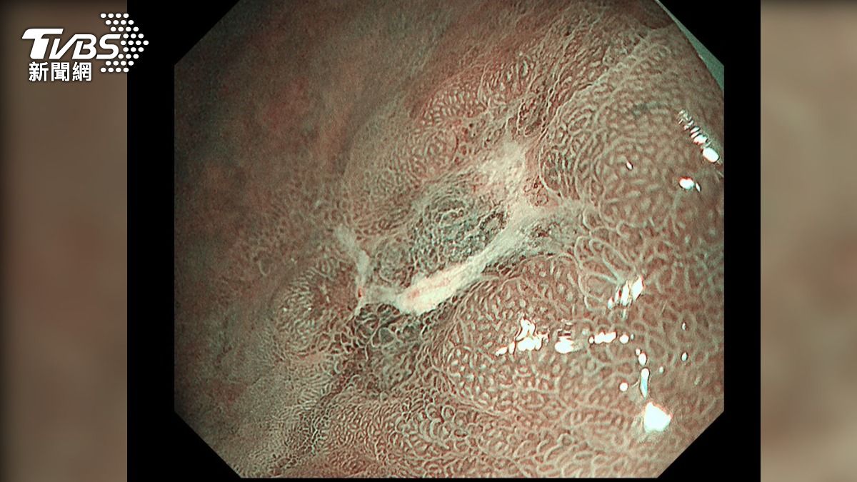 3人就1人中!她「胃遭病菌啃」飯後劇痛 6症狀恐已中晚期癌