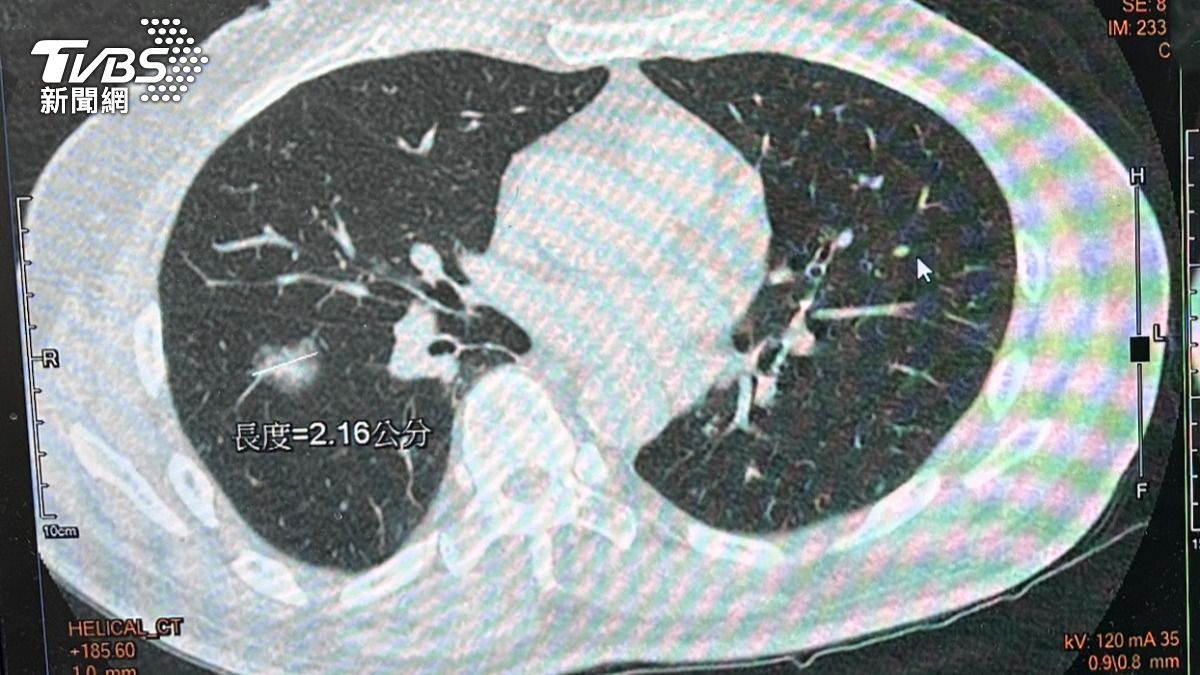 不菸酒僅1因子!台中男肺癌腫瘤滿天星 6症狀恐中晚期了