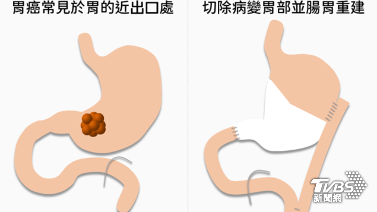 沒減重卻爆瘦5公斤!台中母被愛女拖去醫院 腫瘤塞住癌症了
