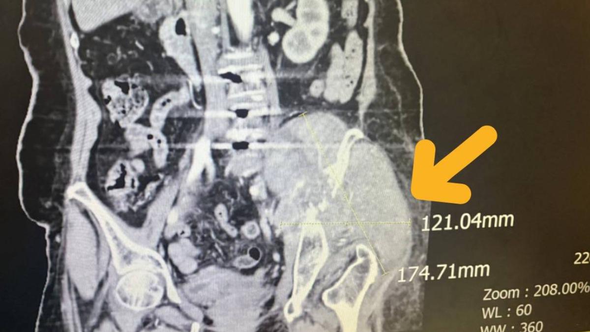 抗癌神器來了!台中女骶骨冒罕見巨型瘤 3個月神速縮小