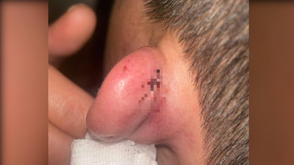 排發財金爆衝突!民眾遭廟方人員甩棍毆打 「耳腫一大包」縫3針