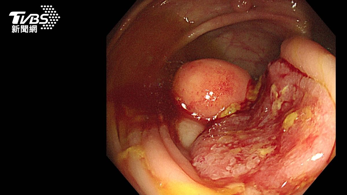 台中翁3非典型症狀!大腸癌四期腫瘤啃腸肝 存活率20%↓