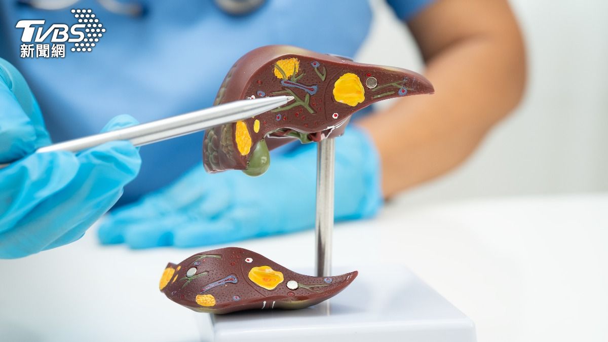 A-Lin曾患脂肪肝!醫揭「泡芙人」危機:每3人就1人中