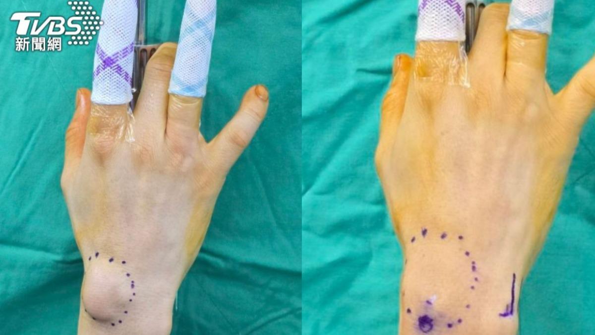 電腦族注意!工程師手腕驚見「剖半乒乓球」 醫示警4高危族群