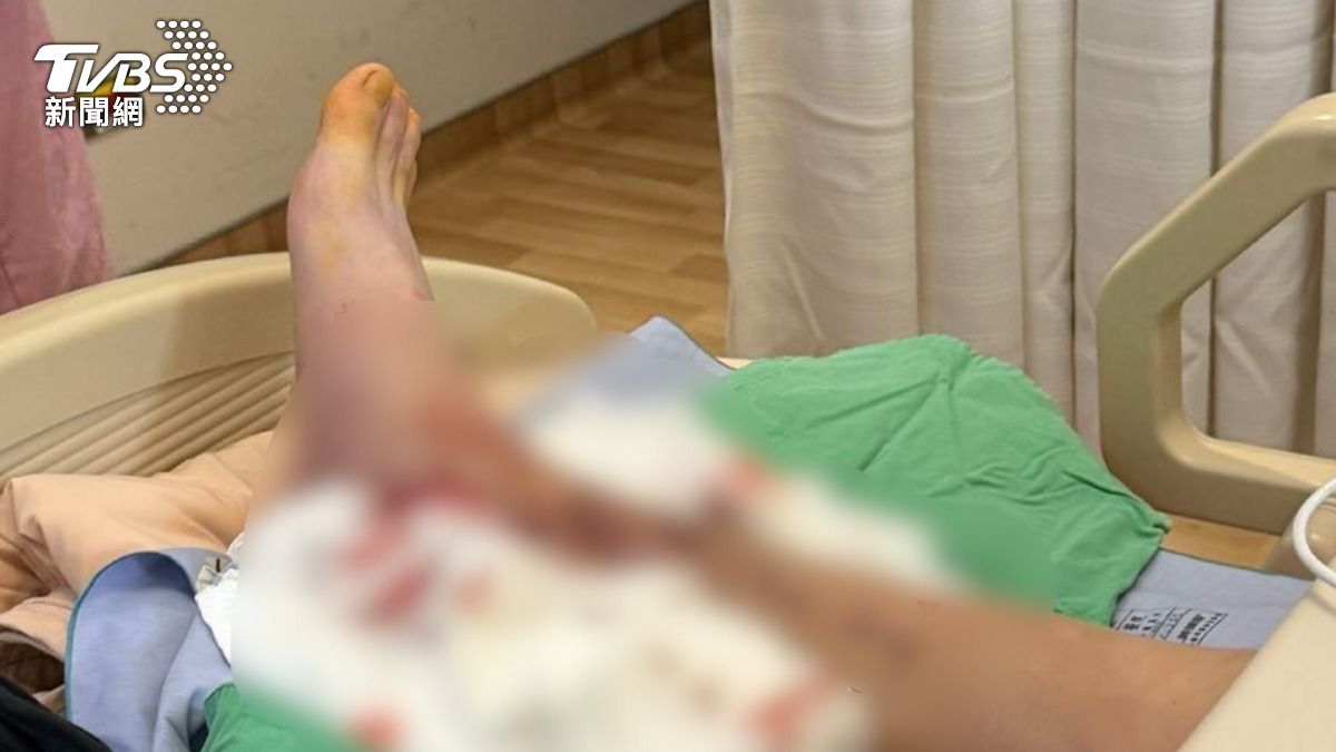 影音/公車擦撞機車「直接開走」!騎士小腿骨折斷3截 復原恐需4個月