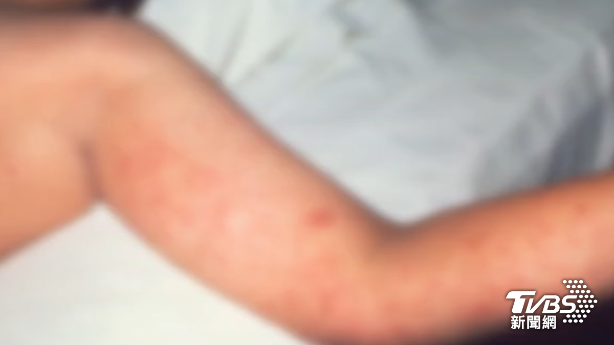 麻疹全球大爆發!日本達近7年新高 醫示警「一般口罩較難防」