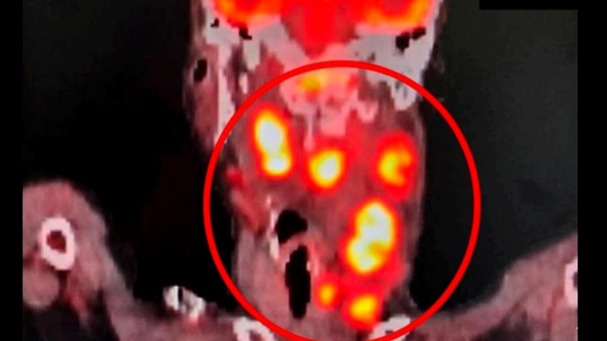 耳鳴聽不見以為老了!他一照「鼻咽癌三期」 10症狀超危險