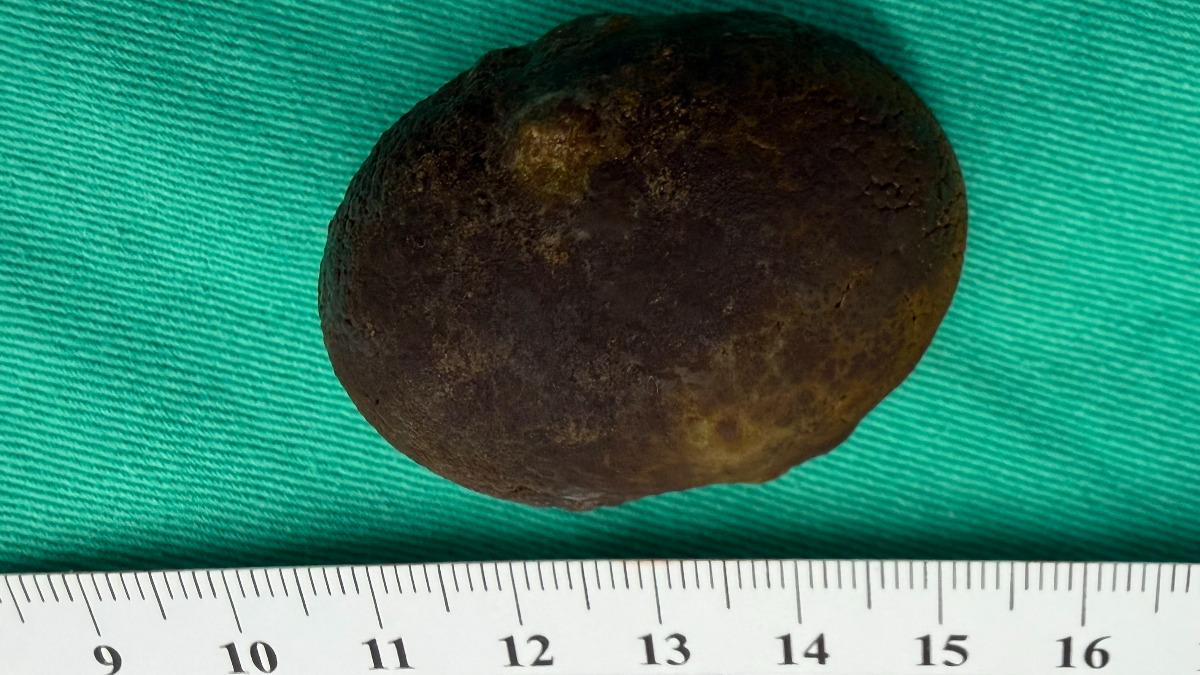 不開刀靠偏方就排膽結石?醫嘆「會害死人」 再拖癌症風險暴增