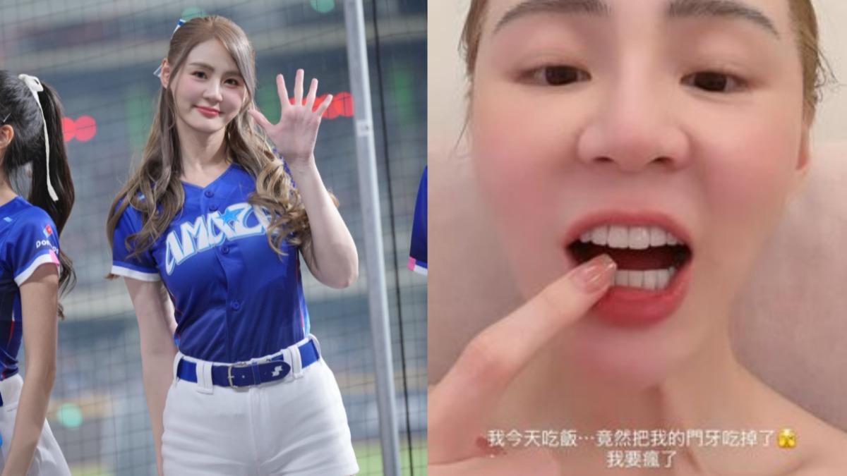 啦啦隊女神短今崩潰!吃飯爆意外「誤把門牙吞下肚」 曬照自嘲:要瘋了