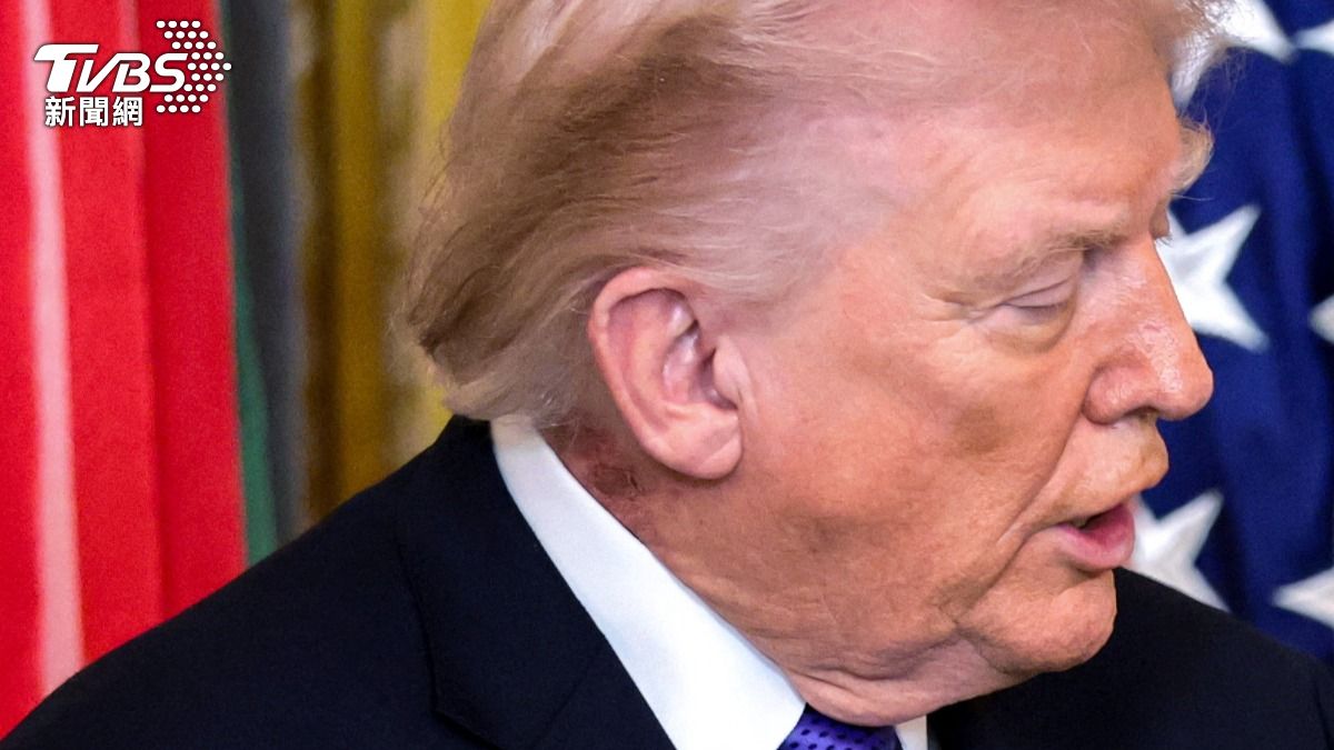 開戰伊朗爆健康惡化!79歲川普「脖子結痂、脫屑」 御醫回應了