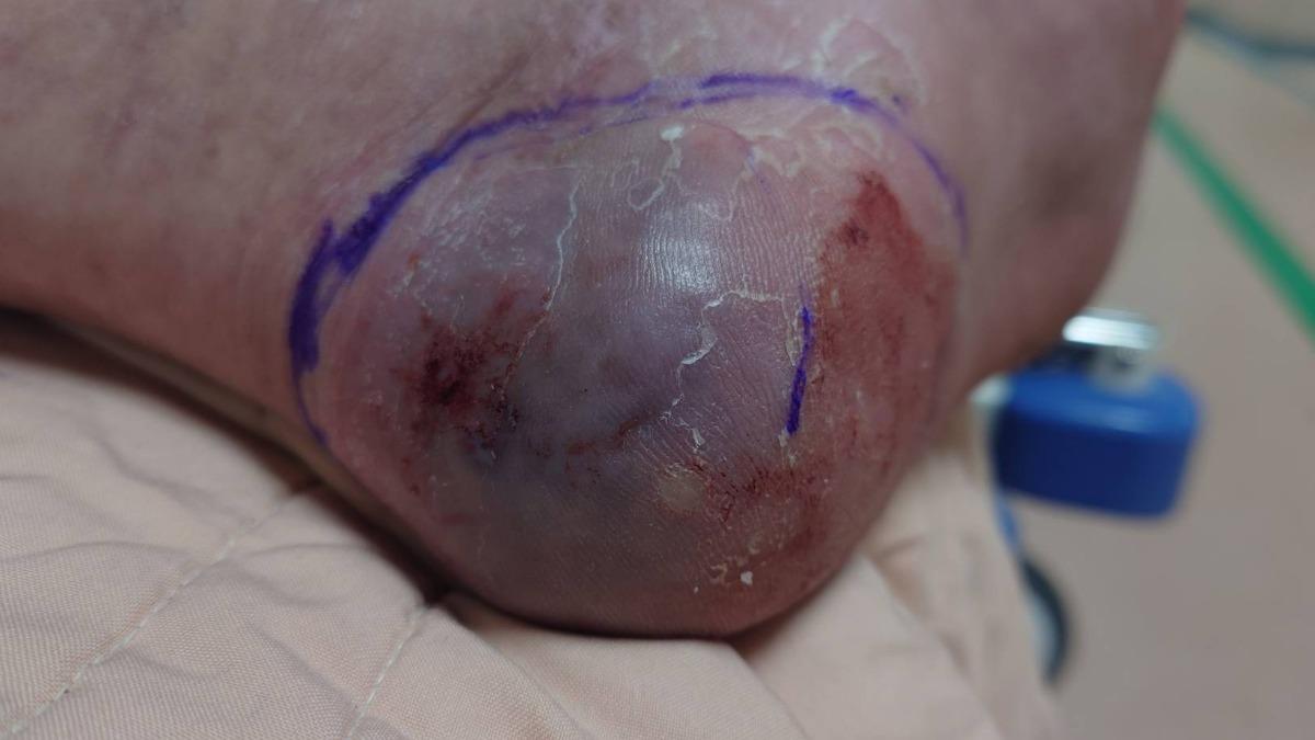 新北新店男在家被咬!竟是毒蛇龜殼花 醫曝救命流程:別用嘴吸