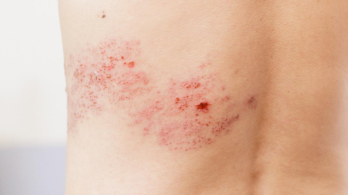 帶狀疱疹一年12萬人!發生率激增1.7倍 青年族群也陷風險