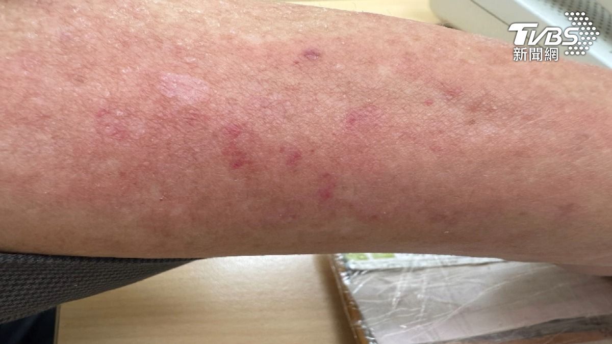 天冷乾燥皮膚狂癢?醫揭冬季癢、冬季濕疹 好發部位與3招止癢!