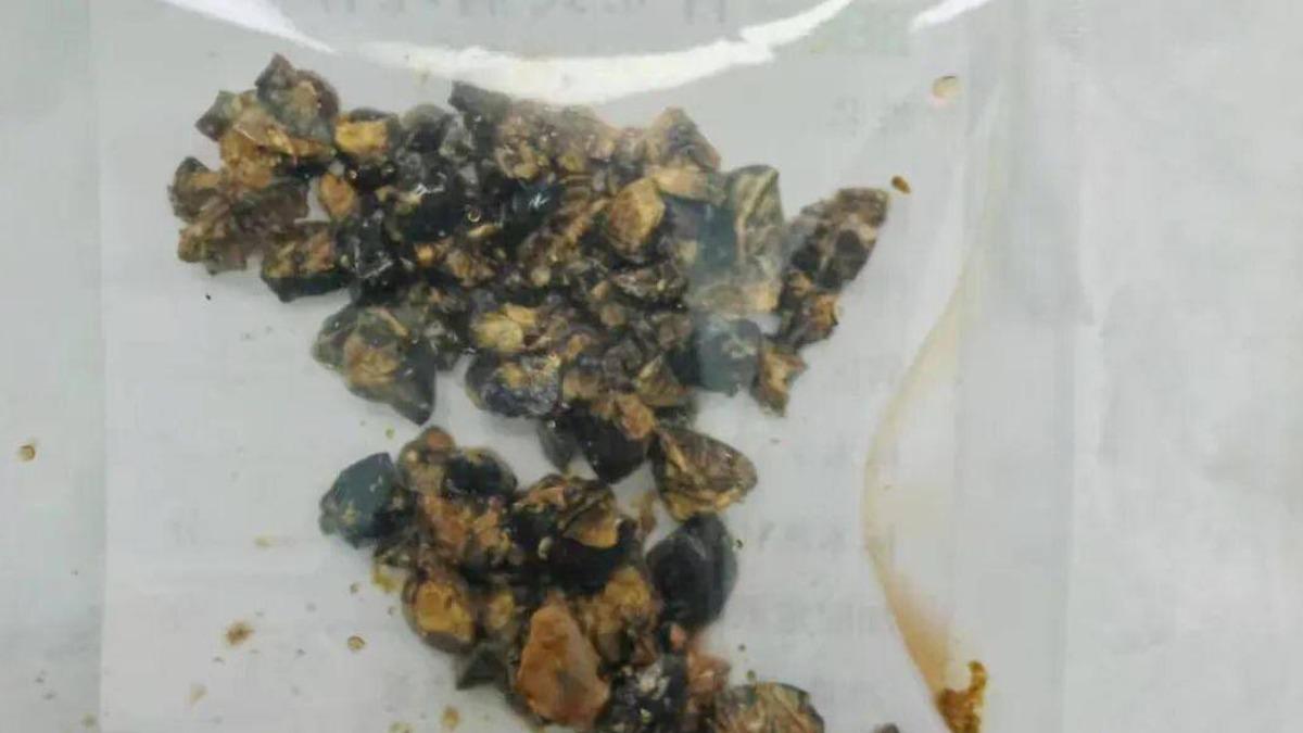 忙工作不吃早餐！陸女腹部劇痛站不直　送醫驚現體內逾60顆結石