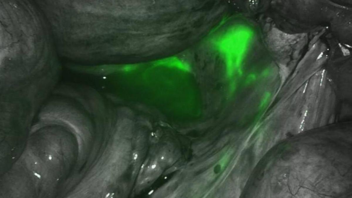 月經還沒來就出血!台中女以為太累拖2個月 驚見無感兇猛癌