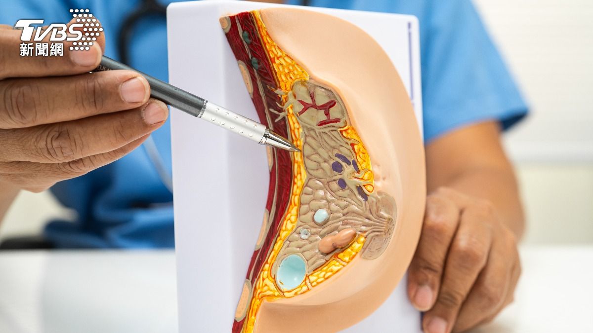 陪病驚覺罹乳癌!腫瘤僅1公分竟已4期 醫籲「這族群」快篩檢