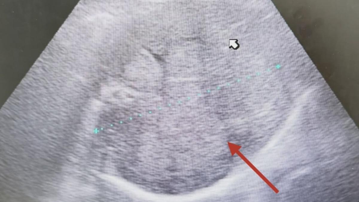 康復就沒事?癌病友7年不追蹤突上腹痛 醫見「腫瘤佔滿肝臟」嚇壞