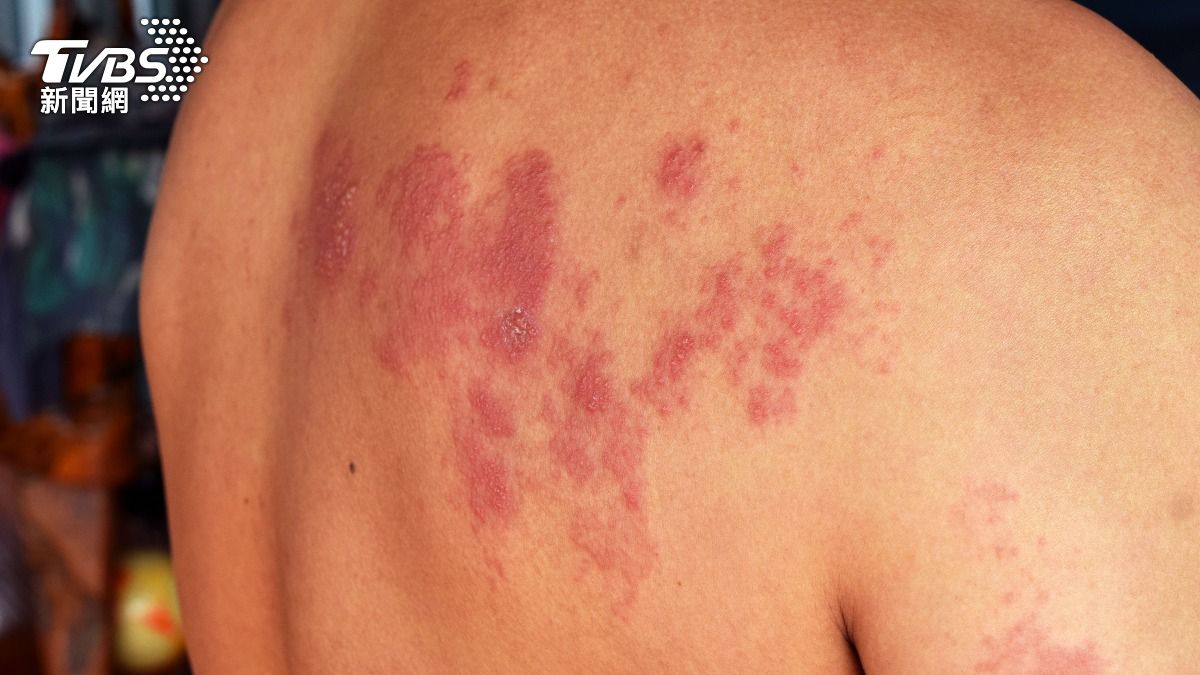 腎友罹「皮蛇」比常人高1.3倍:1情況再飆9倍 醫曝治療地雷