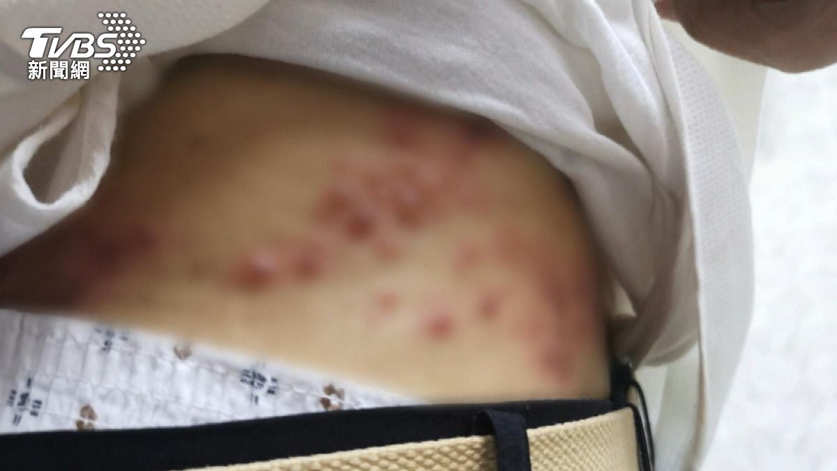 小心皮蛇纏上身!醫揭免疫力下降後 帶狀皰疹復發原因 一次看懂!