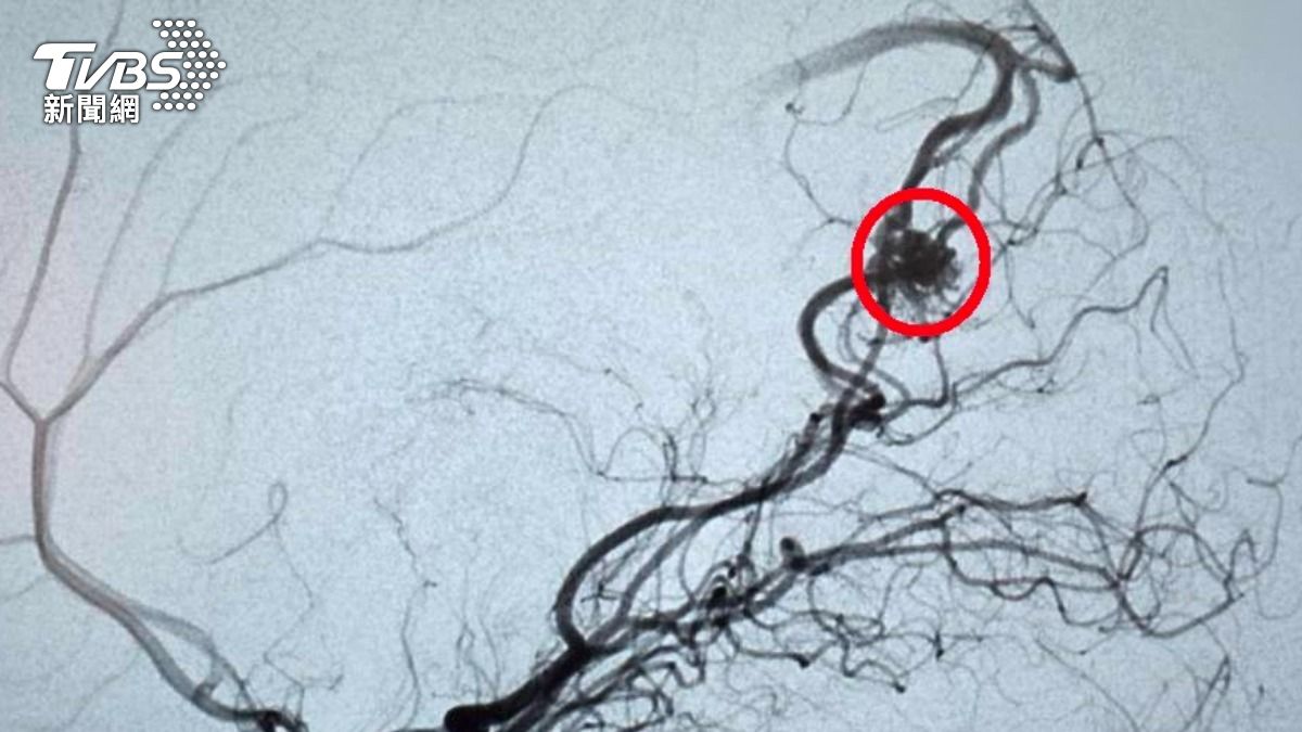 23歲女劇烈頭痛狂吐!一照竟腦出血 醫揭致命真相
