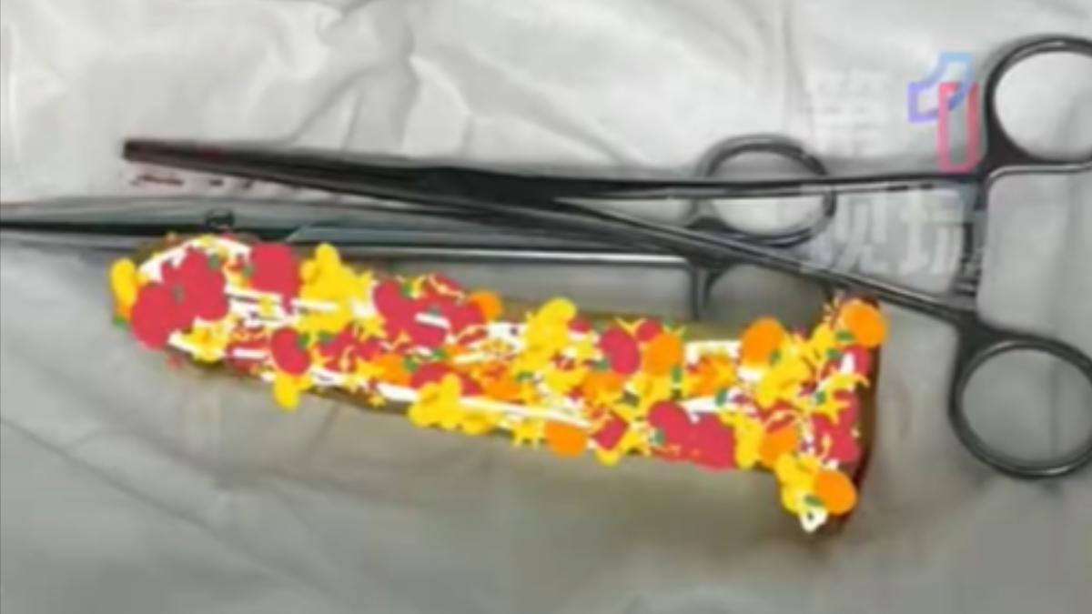 假陽具「滑入肛門」!拖3天慘腸穿孔 陸男稱:不小心坐到