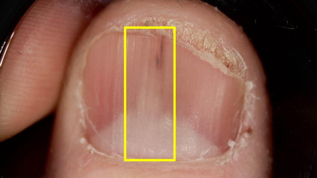 以為富貴手!台中女指甲長出「縱向白線條」 醫搖頭:是腫瘤