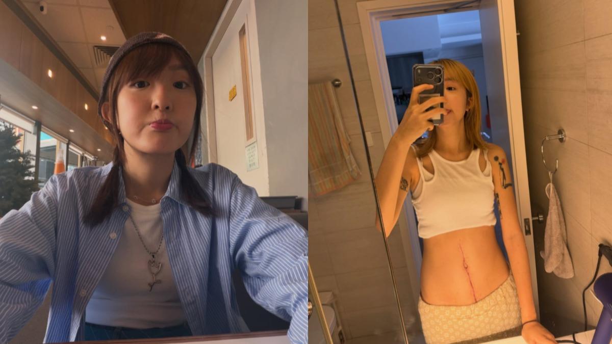 香港YTR曉欣罹卵巢癌!剃光頭、身上劃出「14cm疤痕」