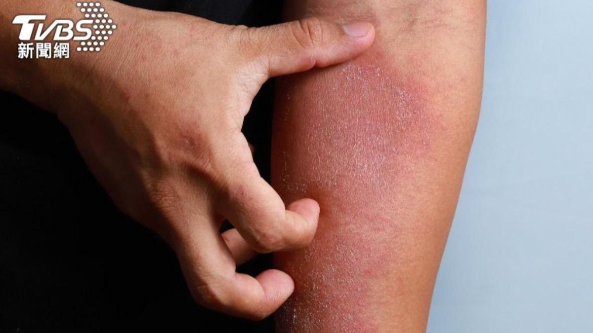 天熱游泳竟全身癢!醫警告:消毒劑氯含量過高「破壞皮膚屏障」