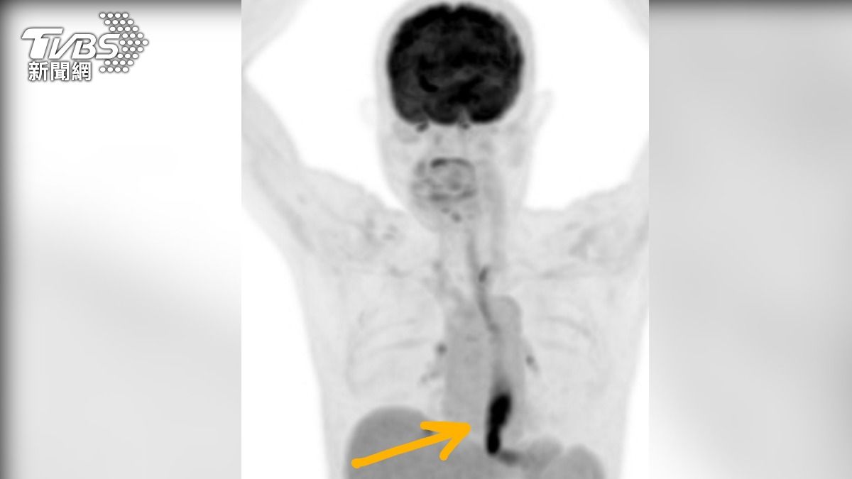 抽菸喝酒40年!台中男吃飯痛拖半個月 腫瘤塞住食道癌三期