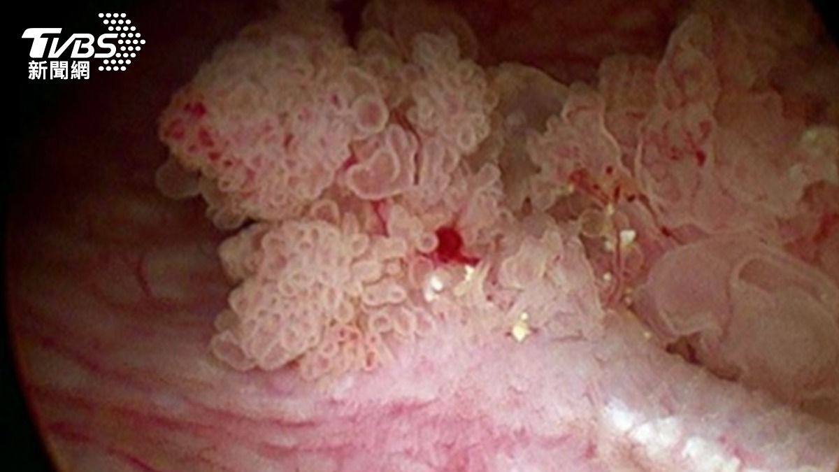 喝水竟害膀胱癌!台中婦無痛血尿腫瘤堵輸尿管 復發率70%