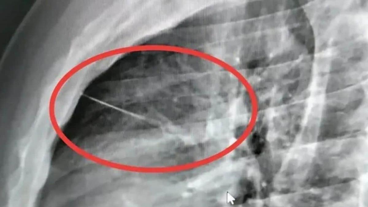 男子胸痛哀號2小時!7cm針「插心臟」命危 家屬疑縫衣針刺入