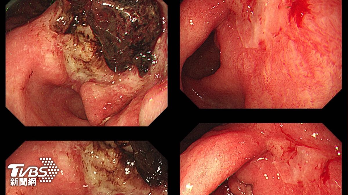 愛吃保健品爆瘦!台中翁胃癌三期判難開刀 腫瘤神奇縮小治癒