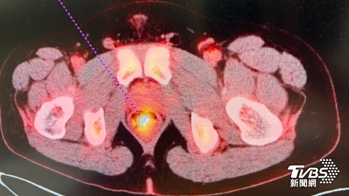 愛吃1食物!台中男便秘十年拉出血便 26歲就中直腸癌三期