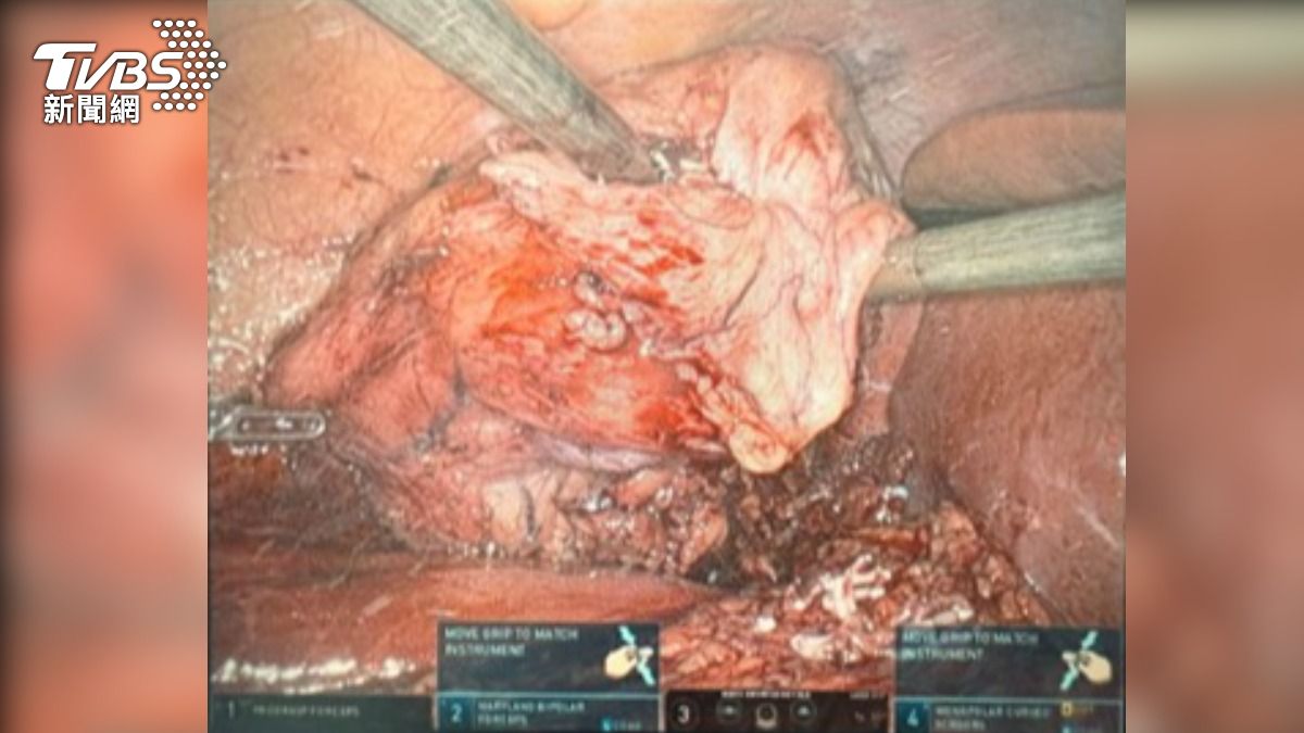 1症狀放著不管!台中男泌尿道上皮癌 再拖第四期20%能活