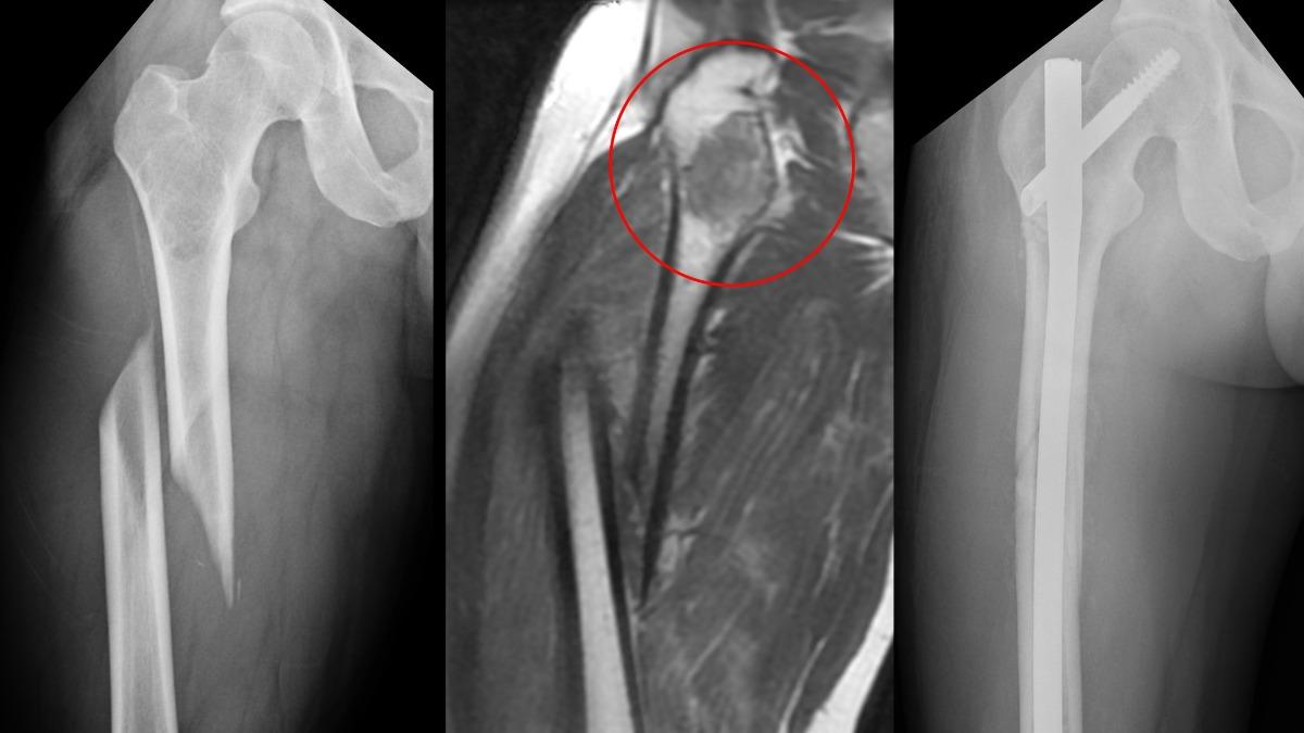 滑雪摔斷腳!台中男大腿變形 一照骨頭意外揪無徵兆神秘腫瘤