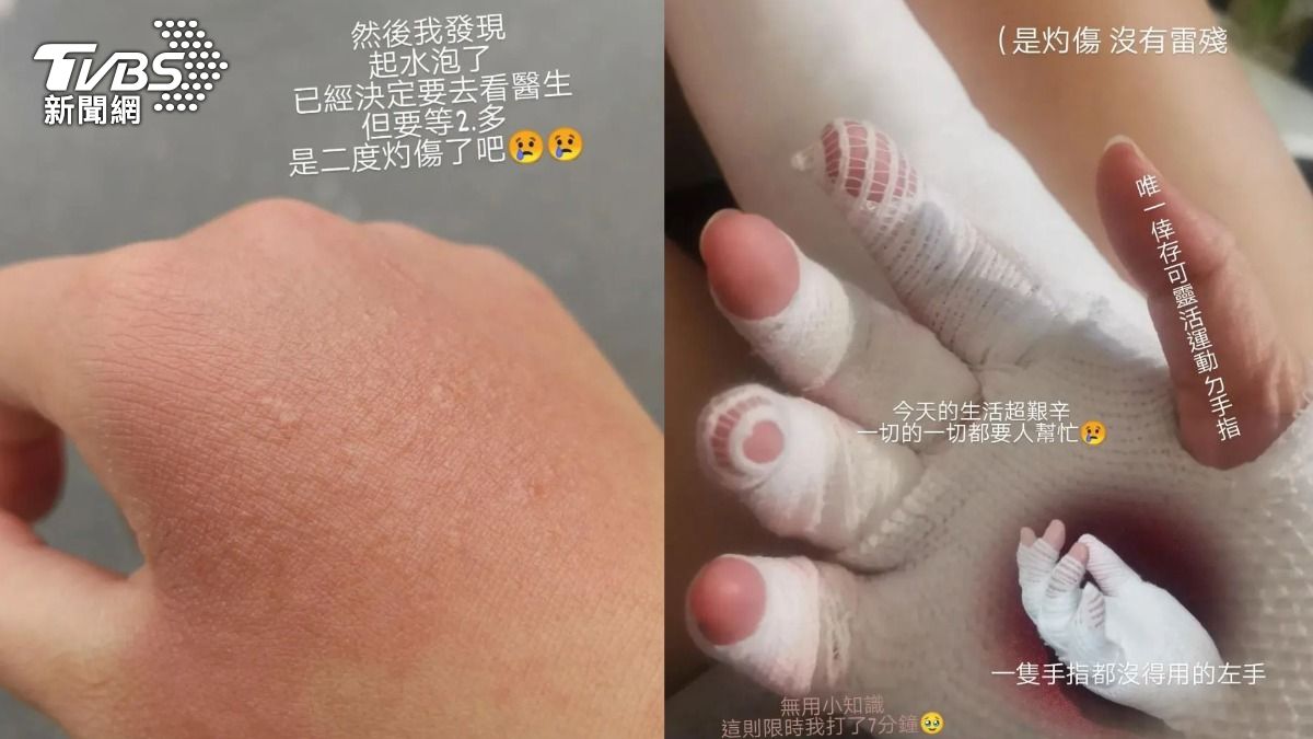 她擠檸檬少1動作!曬太陽慘「灼傷」變70歲阿嬤手 醫揪恐怖元凶
